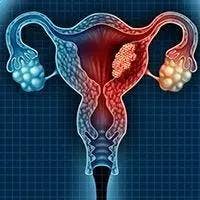 Pembrolizumab/Lenvatinib Approved in Japan for Endometrial Cancer Following Progression on Chemo