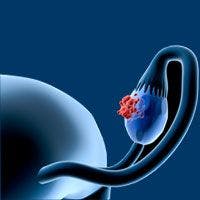 Novel Agent Anchors Triplet Regimen in Ovarian Cancer Trial