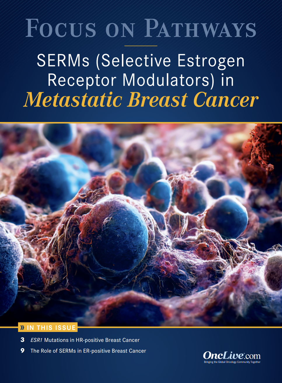 Focus on Pathways: SERMS in Metastatic Breast Cancer