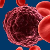 Allogeneic SCT Benefits Children and Adolescents With Relapsed Anaplastic Large Cell Lymphoma 