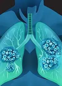 Sunvozertinib in EGFR exon 20–positive NSCLC | Image Credit: © blueringmedia - stock.adobe.com