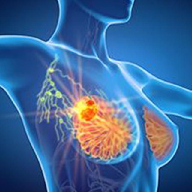 Pyrotinib Plus Metronomic Vinorelbine in HER2+ Advanced Breast Cancer | Image Credit: © Axel Kock - stock.adobe.com