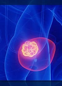 Urothelial Cancer