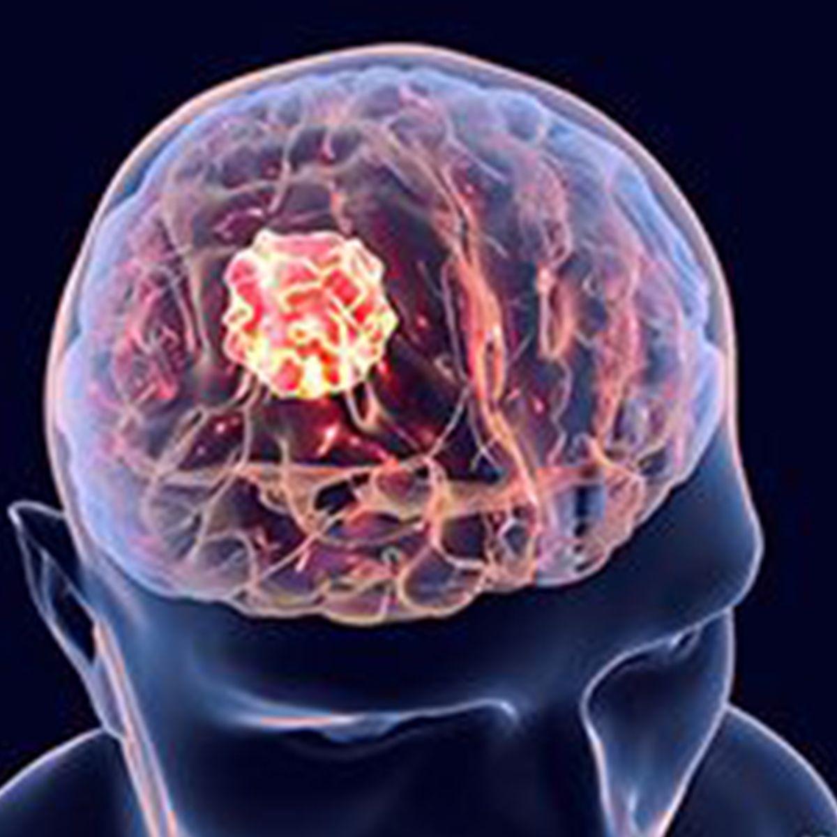 MTX110 in Recurrent Glioblastoma | Image Credit: © Dr_Microbe - stock.adobe.com