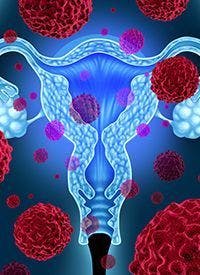 Dostarlimab/Chemotherapy in Endometrial Cancer | Image Credit: © freshidea - stock.adobe.com