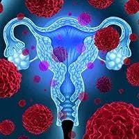 Dostarlimab/Chemotherapy in Endometrial Cancer | Image Credit: © freshidea - stock.adobe.com