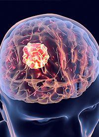 MTX110 in Recurrent Glioblastoma | Image Credit: © Dr_Microbe - stock.adobe.com