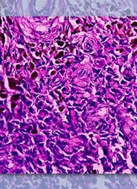 Fixed-Dose CAR T Cells and UB-TT170 in R/R Osteosarcoma | Image Credit: © MdBabul - stock.adobe.com