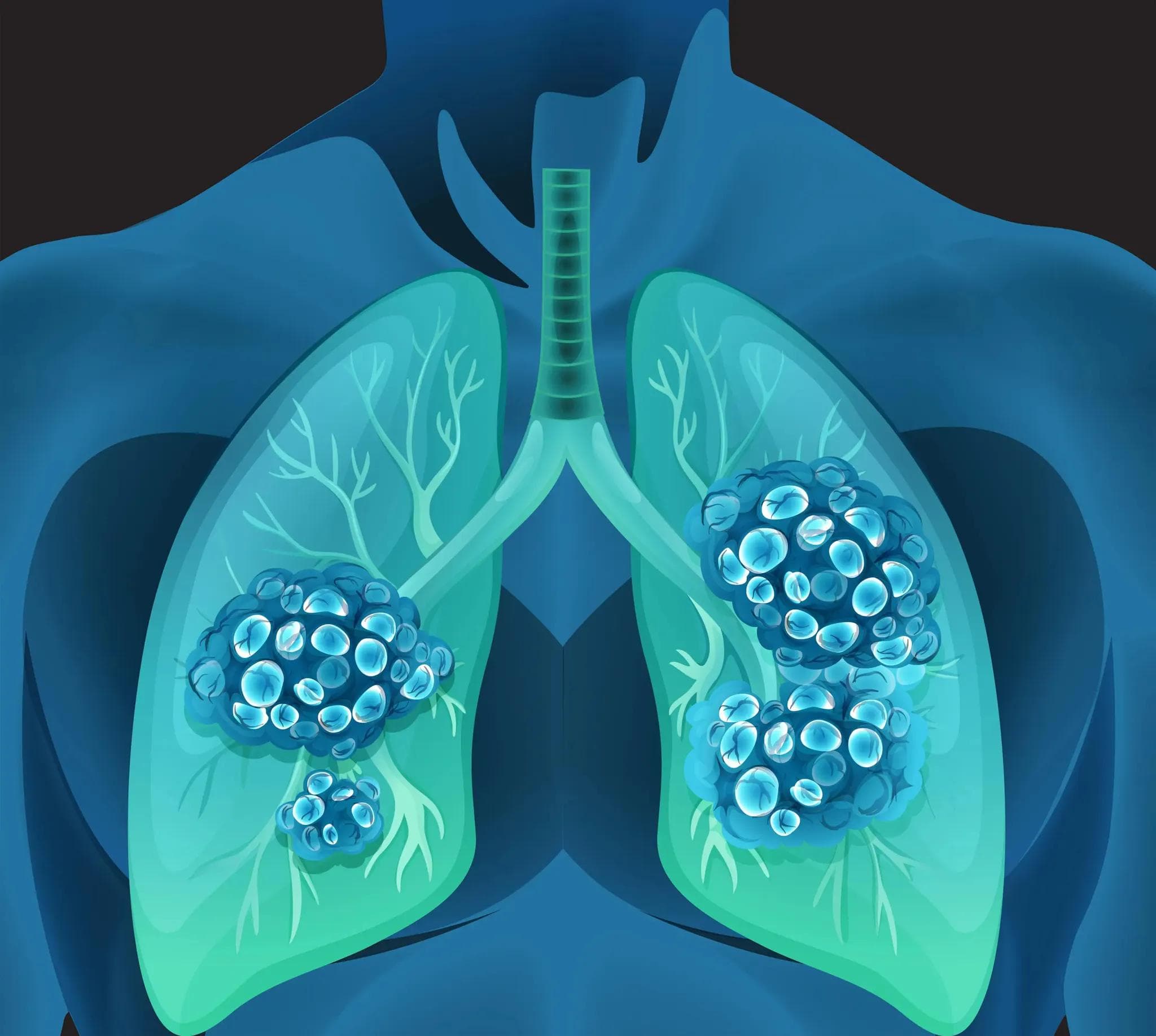 The Rapidly Evolving Treatment Landscape of Stage I-IIIB NSCLC and its Implications to Clinical Practice